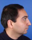 After Hair Transplant&nbsp;Front